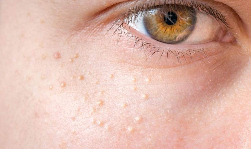 Best Drugstore Products for Milia